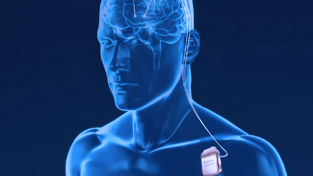 Deep Brain Stimulation