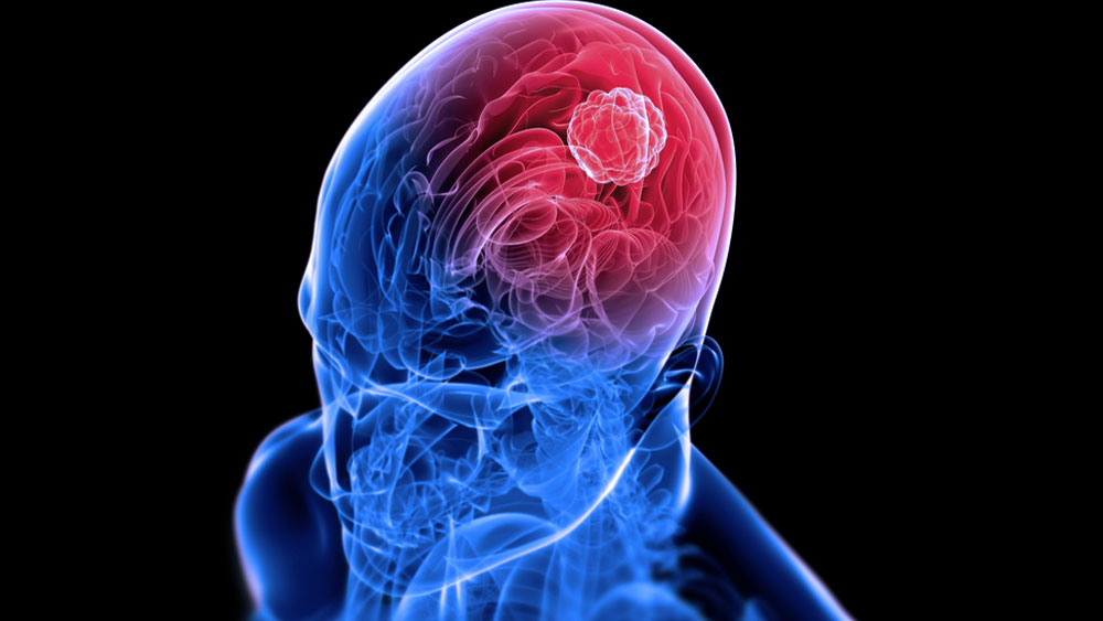 Brain Tumors