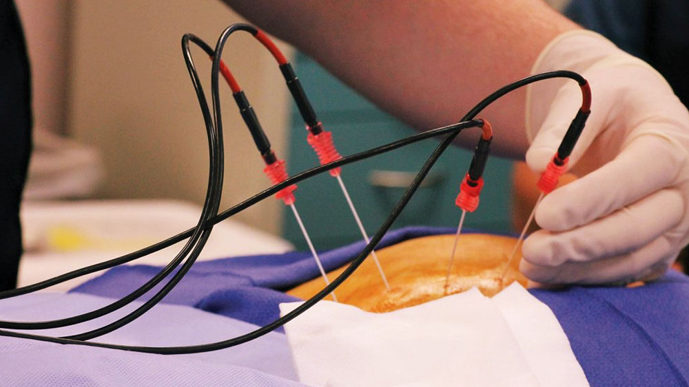 Pain Treatments