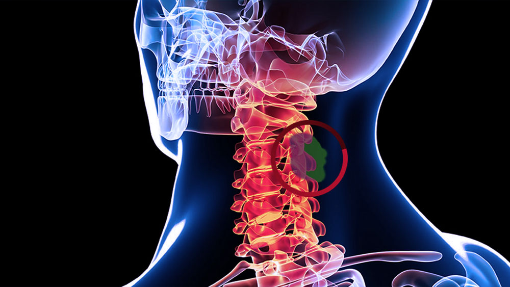 Spinal Tumors