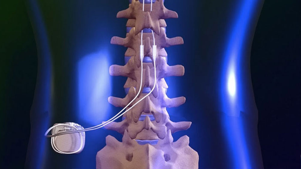 Spinal Cord Stimulation Surgery